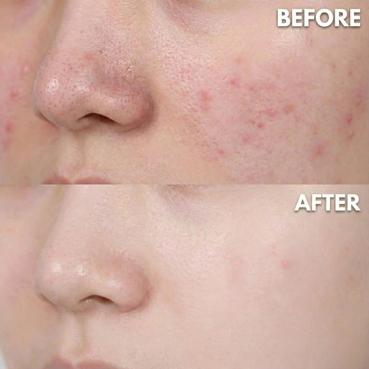 Yume Radiance LED Light Therapy Mask