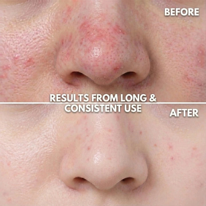 Yume Radiance LED Light Therapy Mask