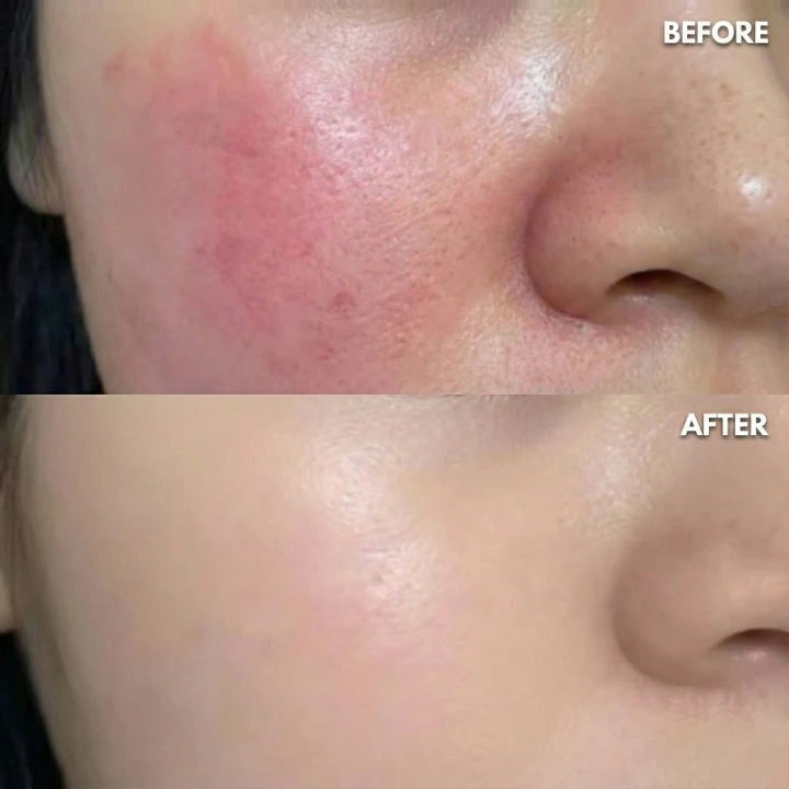 Yume Radiance LED Light Therapy Mask